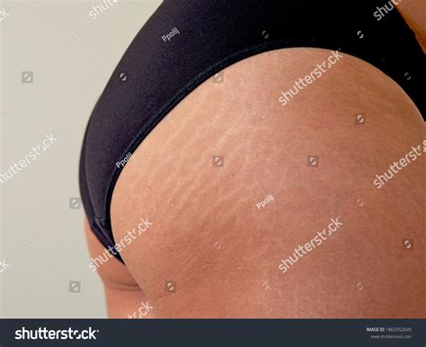 1,714 Stretch Marks On Female Legs Images, Stock Photos & Vectors | Shutterstock