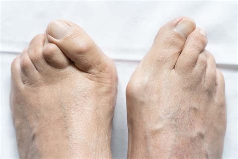 Hammertoes | Nova Family Podiatry
