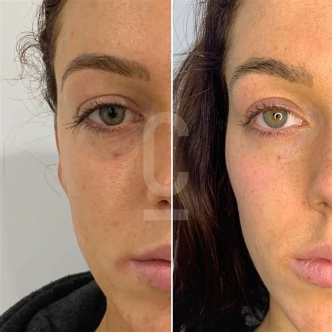 You Need To Know About Truth Facial Filler Migration