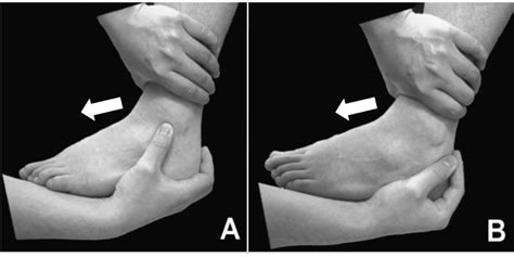 Ankle laxity examinations are demonstrated on a left ankle; the ...