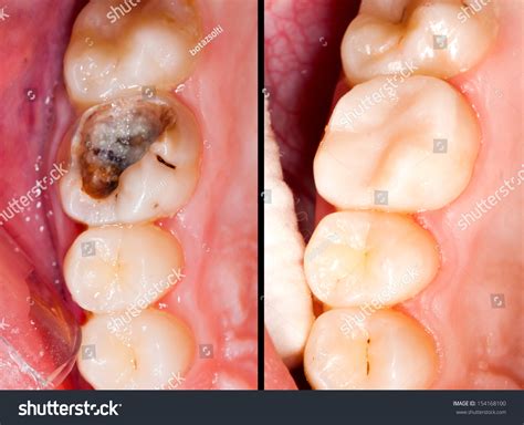 Dental Cavity Pictures