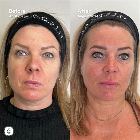 Sculptra | Age Reverser | Sarasin Clinic