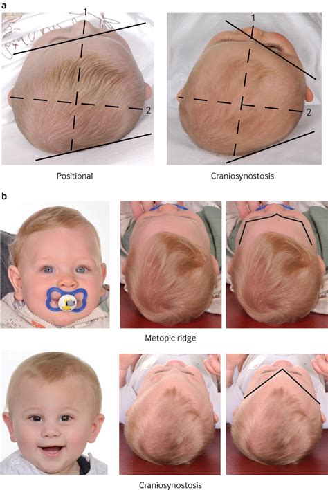 Recognising a child with isolated craniosynostosis | The BMJ