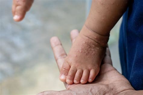 Hand Foot and Mouth Disease Archives - KAYA 959