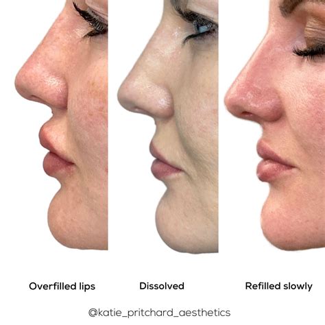 Before and After Filler Dissolver Photo Gallery - Remarkable Results