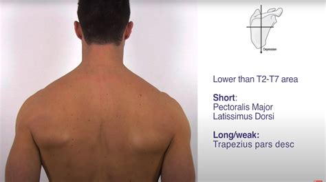 Scapular Alignment | Scapular Dyskinesis Bewertung