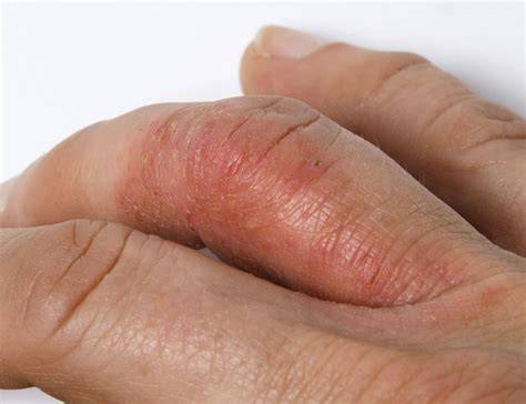Progressive joint pain and swelling | Psoriatic Arthritis Challenge Center