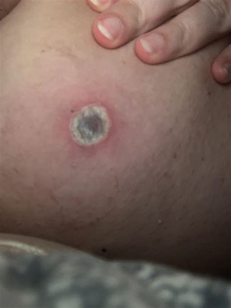 Skin tag removal area still hasn’t healed, cut off 6-22, raised edges ...