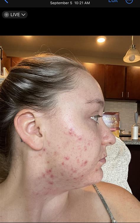 Almost 3 months on Tazorac (Tazarotene) 🙏 with hormonal cystic acne : r/tretinoin