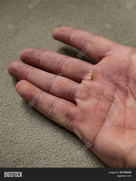 Callus Hand