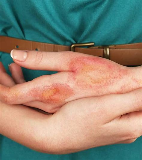 Ice Burn: Causes, Symptoms & 11 Home Treatment Tips