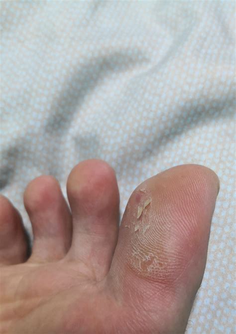 Toe Skin Peeling Skin Peeling Between The Toes: What It Means