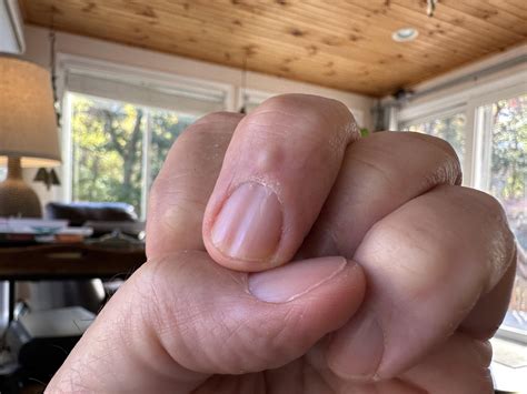 What’s under that skin bump causing a nail deformation? How to treat ...