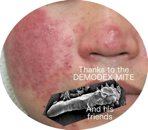 Why Demodex Mites Symptoms and Infestation Require Immediate Attention - Mite Infestation