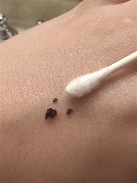 Combination of wax and clotted/dried blood that emerged from my ear this past weekend ...