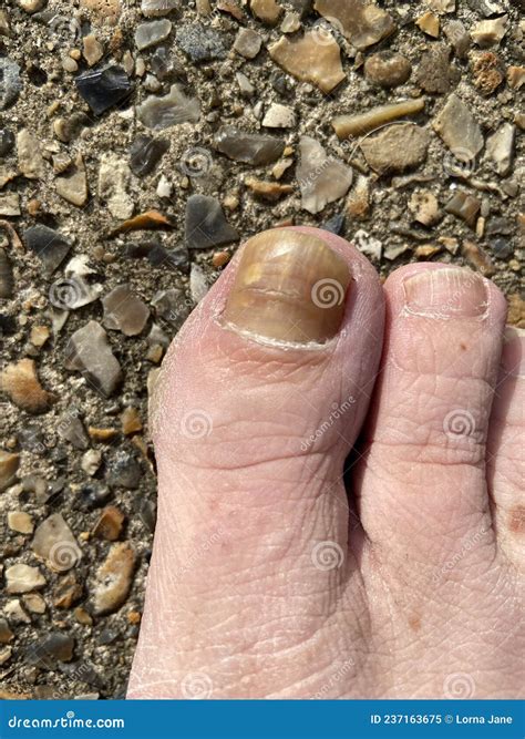 Toenail Care for Nail Fungus - Thickened Big Toe Nail of a Person Suffering from Onychomycosis ...