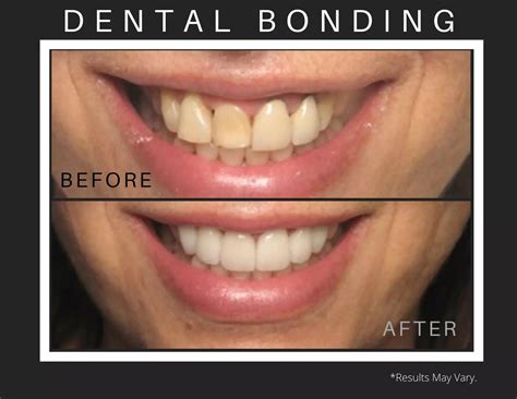 What Is Cosmetic Dental Bonding at Danielle Oxford blog