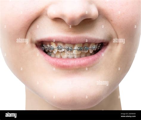 front view of metal dental braces on teeth of upper jaw of girl closeup cutout on white ...