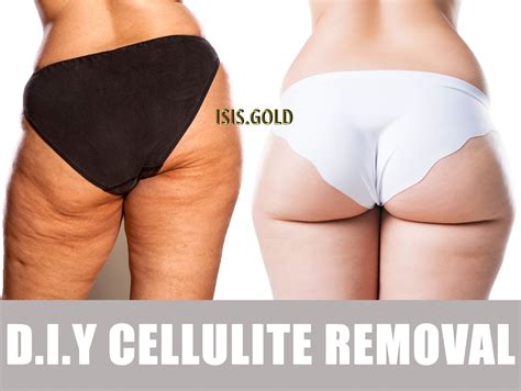 Mild Cellulite