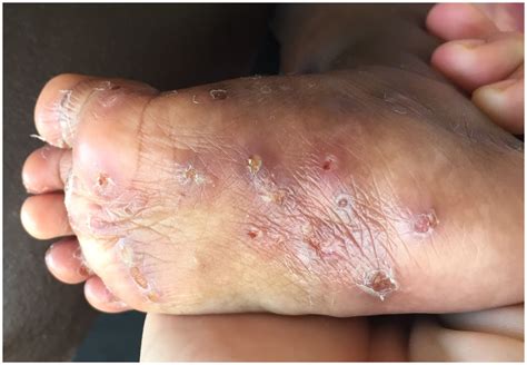 Frontiers | Scabies: current knowledge and future directions