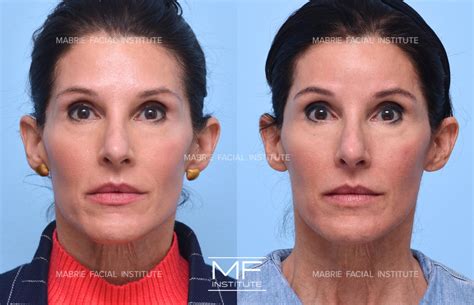 Sunken Temples Before and After Pictures Case 771 | San Francisco, CA ...