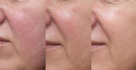 Rosacea Laser Treatment Bruising