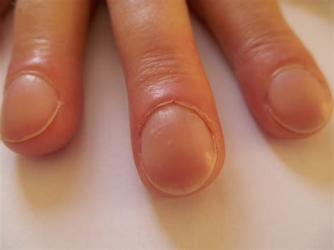Why Do I Have Clubbed Fingernails at Lara Bunton blog
