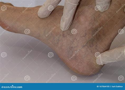 Symptoms of Varicose Veins Disease Stock Image - Image of clinic, elderly: 167064105