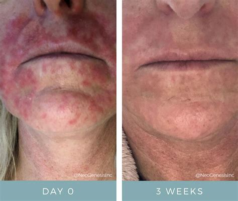 Best Facial Cream During Chemo at Darnell Johnson blog