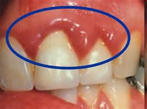 Gum Infection: What It Is And How To Treat It | OraMD