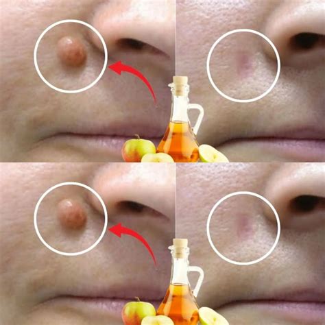 Apple Cider Vinegar: A Natural Solution for Removing Warts in 24 Hours