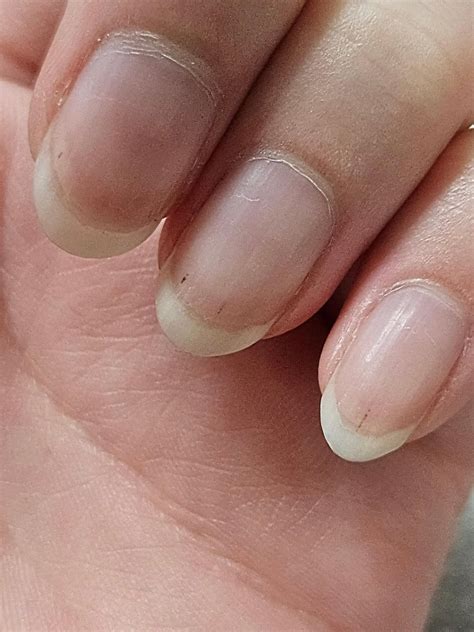 Black Spots On Nail Bed 12 Nail Changes A Dermatologist Should Examine