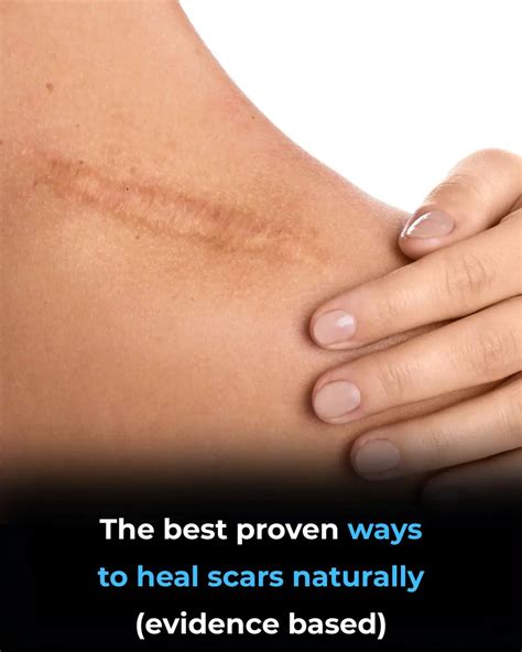 The Best Proven Ways to Heal Scars Naturally (Evidence Based)