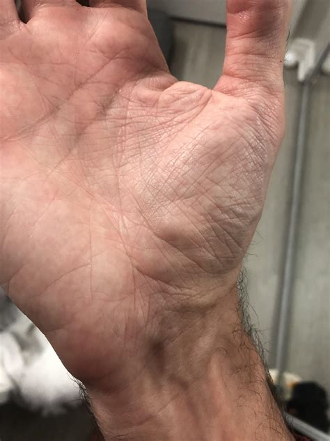 Bulging Veins On Finger | Bulging Veins In Hands – SRYQ