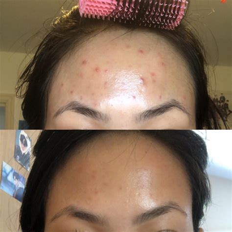Glycolic Acid Before And After Photos