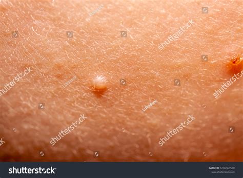 Close Molluscum Contagiosum Called Water Wart : photo de stock ...