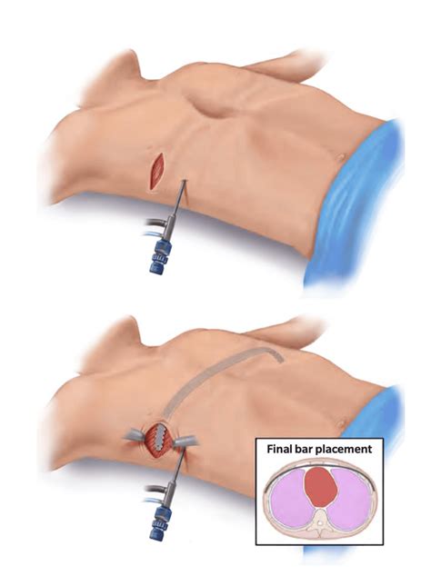 Nuss Procedure for Pectus Excavatum Surgery in India