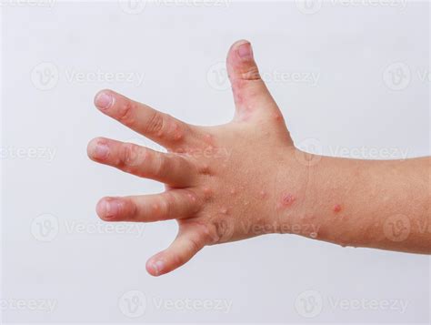 Hand Foot And Mouth Disease In Adults Antibiotics at Raymond Terrell blog