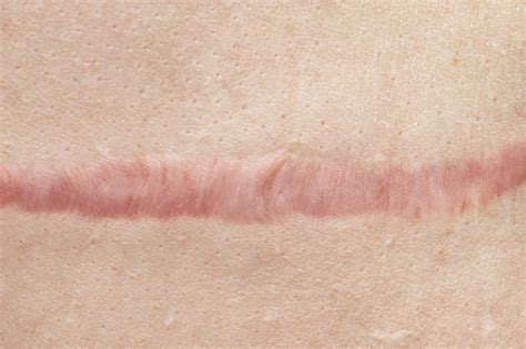 Topical Treatments for Keloids and Hypertrophic Scars Lack Widespread ...