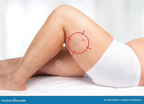 Removal of Varicose Veins on the Legs. Medical Inspection and Treatment of Telangiectasia Stock ...