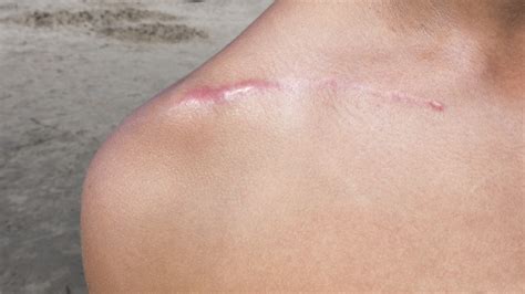 A Closer Look: C-Section Incision Types - Rejûvaskin