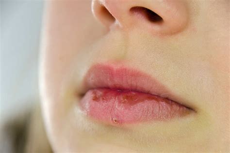 Bumps on Lips Small, Little, White or Red Causes & Treatment - American ...