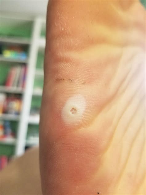 Crater Wart On Foot Clearance | emergencydentistry.com