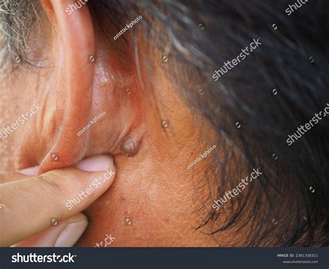 Cyst Behind Ear