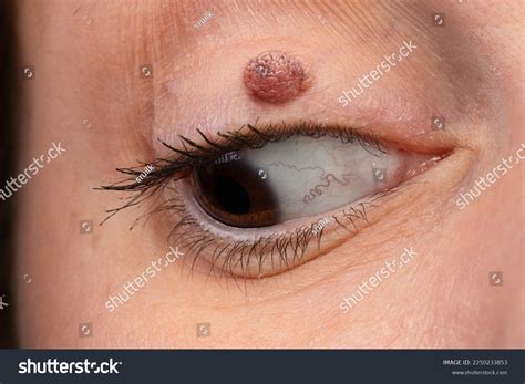 Womans Eye Eyelid Melanocytic Nevus Keratin Stock Photo 2250233853 | Shutterstock