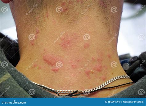Red Rash On Neck Allergy at Alfred Ma blog