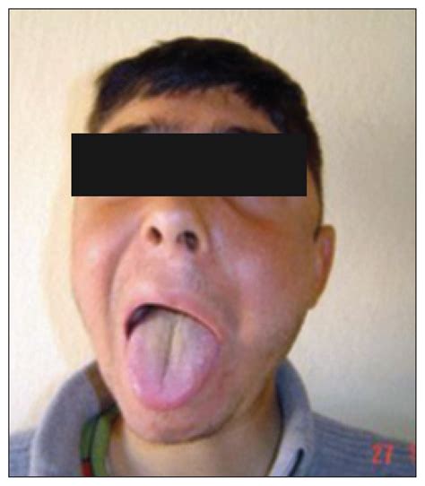 Melkersson-Rosenthal syndrome with partial oculomotor nerve palsy | Annals of Saudi Medicine