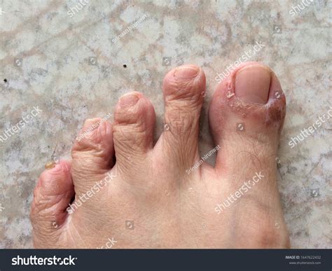 Why Does My Skin Peel Between Toes at Heather Sasso blog