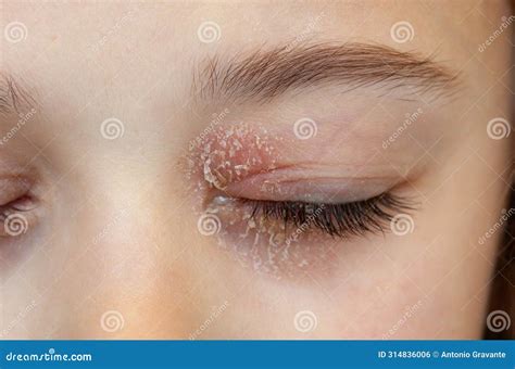 Closed Eye Of A Little Girl Suffering From Ocular Atopic Dermatitis Or ...