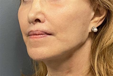 fenale face reshaping oblioque 2 - Explore Plastic Surgery